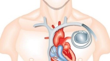 Implanted medical device